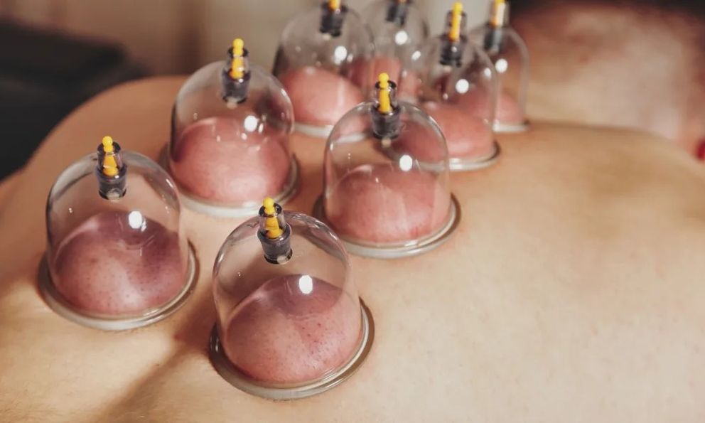 Giác hơi vùng cổ, người đàn ông 37 tuổi đột quỵ liệt nửa người: 1 thói quen TAI HẠI nhiều người Việt làm mỗi ngày