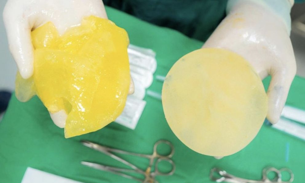 Bác sĩ cảnh báo KHẨN: Người chơi pickleball gặp 5 dấu hiệu này có thể đang vỡ túi ngực