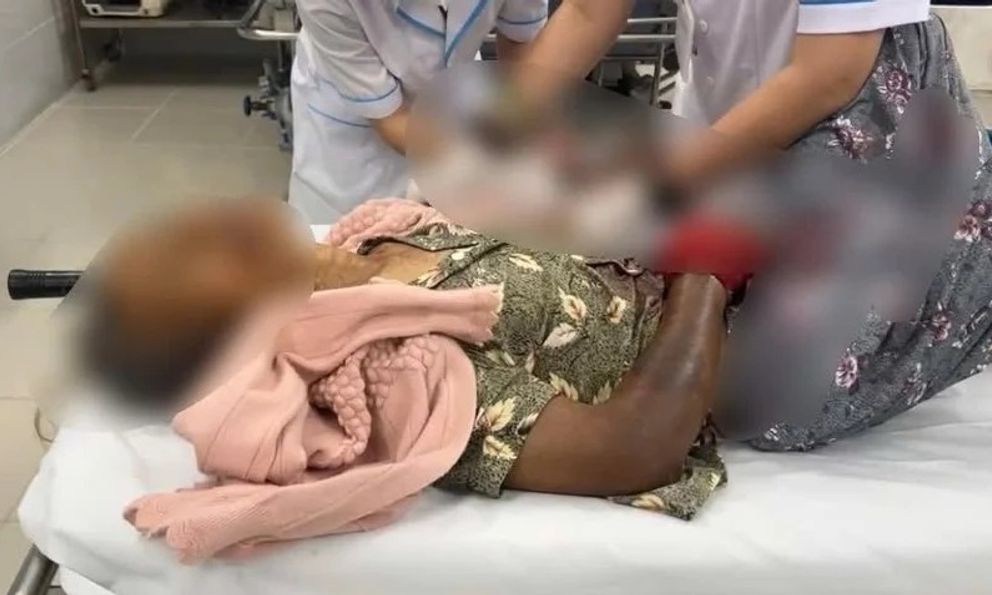 Tin lời chữa rắn cắn theo mẹo dân gian, người phụ nữ 76 tuổi nguy kịch: Sai lầm tai hại!