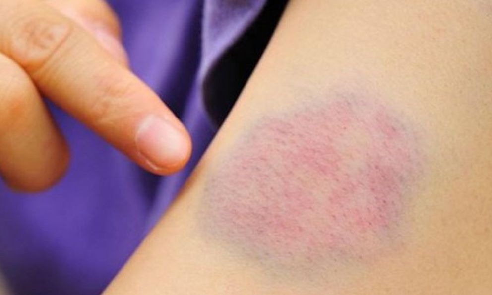 5 dấu hiệu nhỏ trên da 