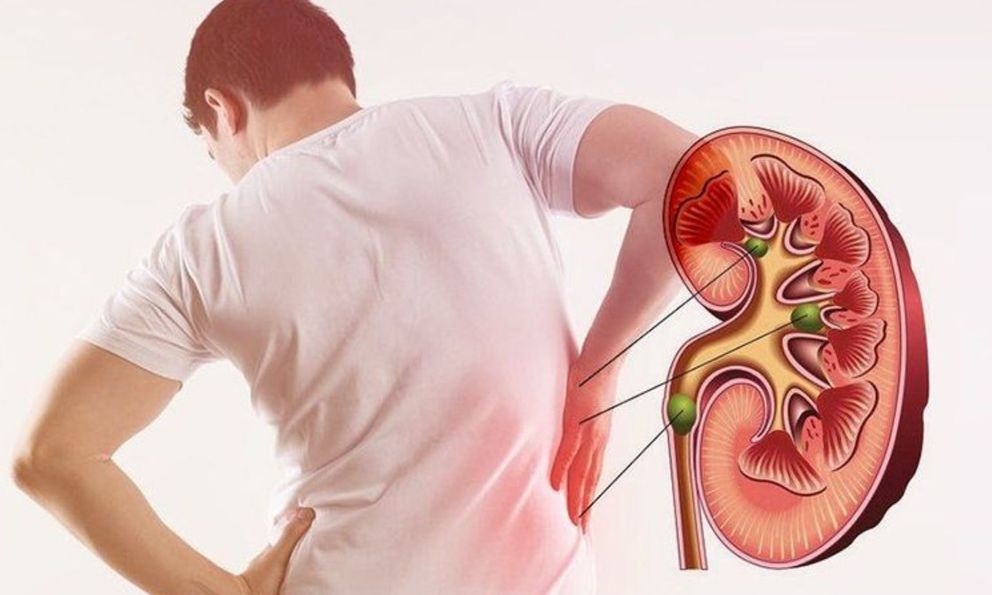 Bác sĩ hướng dẫn theo dõi 4 triệu chứng suy thận giai đoạn sớm: Âm thầm nhưng cực nguy hiểm