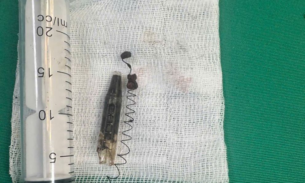 13 năm bị găm đầu bút bi ở vùng thái dương chỉ vì một lần nô đùa: Bác sĩ cảnh báo không thể chủ quan với vết thương nhỏ