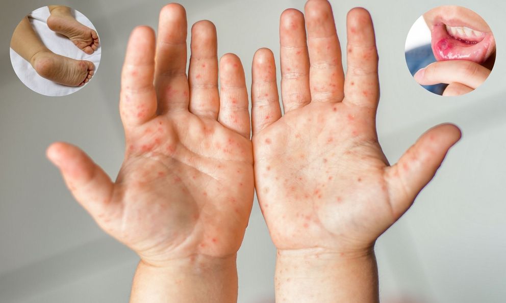 Bệnh dịch này đang gia tăng ở TP.HCM, hơn 8.000 ca mắc, 3 trẻ tử vong