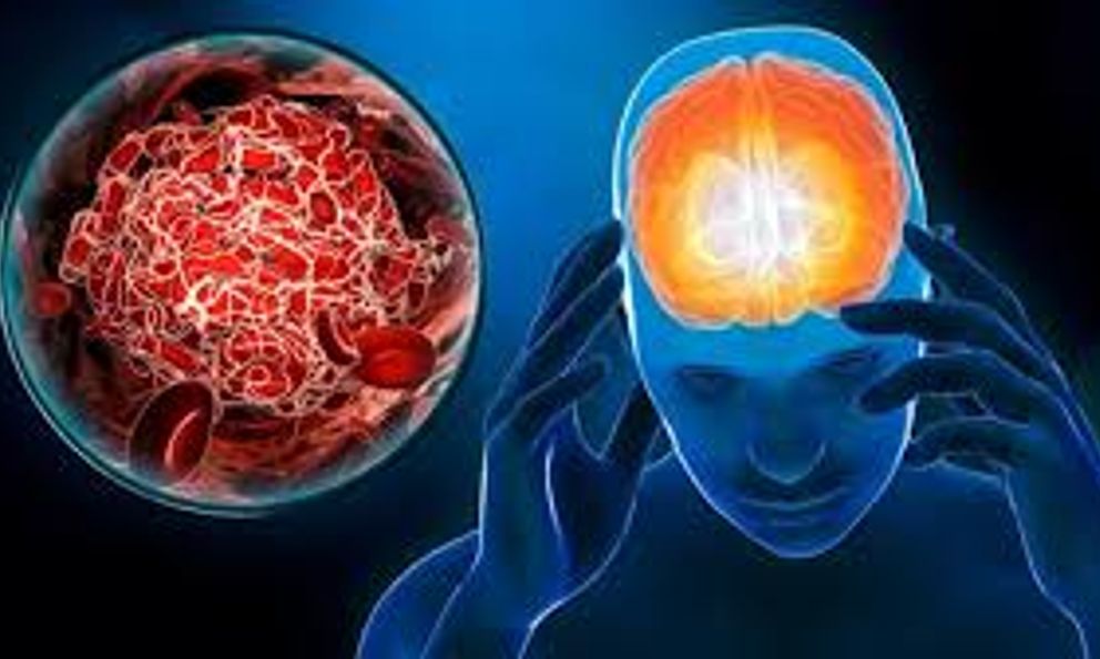 Không phải tê bì tay chân, chuyên gia chỉ thẳng 6 DẤU HIỆU của đột quỵ: Nhiều người Việt gặp hằng ngày nhưng lại nghĩ “không sao”