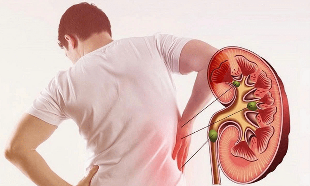 Tỷ lệ suy thận tăng nhanh: Bác sĩ nhắc, hàng ngày thường xuyên làm 4 VIỆC khiến thận 