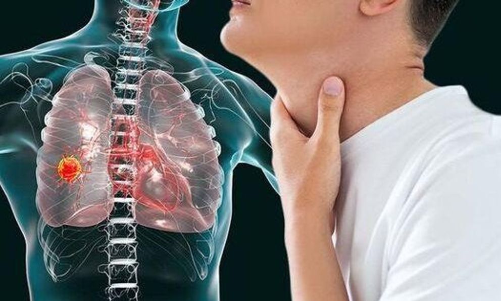 Không phải ho dai dẳng: 5 DẤU HIỆU cảnh báo ung thư phổi nhiều người vẫn lầm tưởng là bình thường