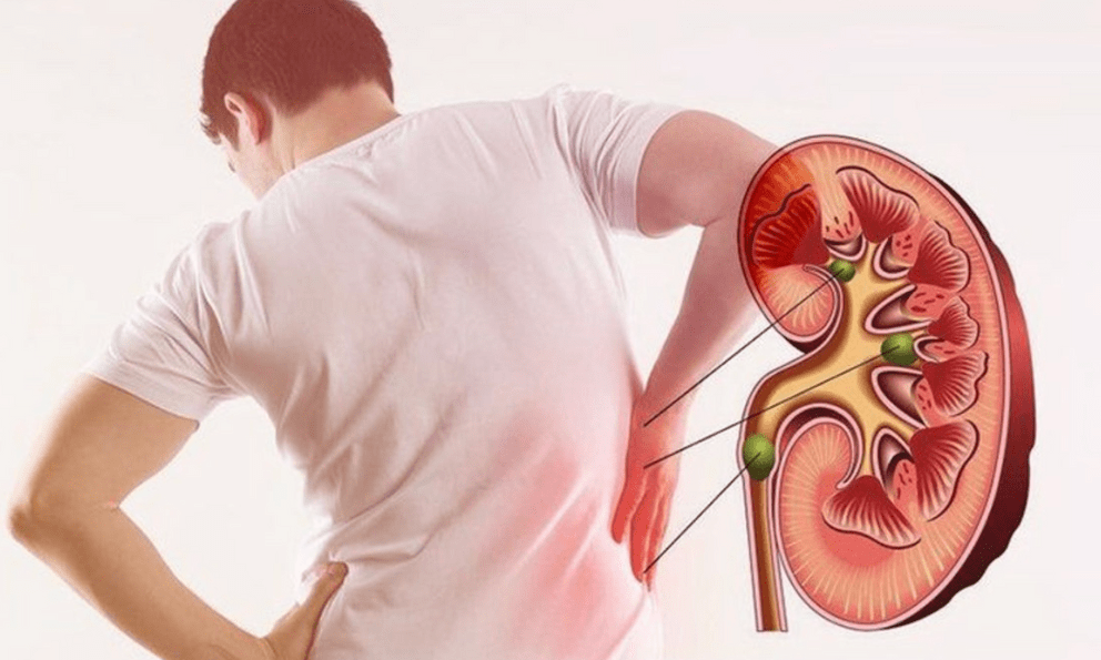 Bác sĩ cảnh báo: Xuất hiện 5 BIỂU HIỆN này có thể là dấu hiệu suy thận, nhiều người nhầm với đau lưng thông thường