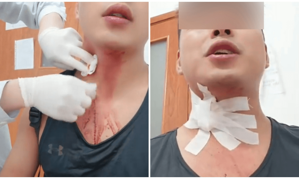Khó tin: Nhập viện do vỡ tĩnh mạch sau khi cố đập... muỗi