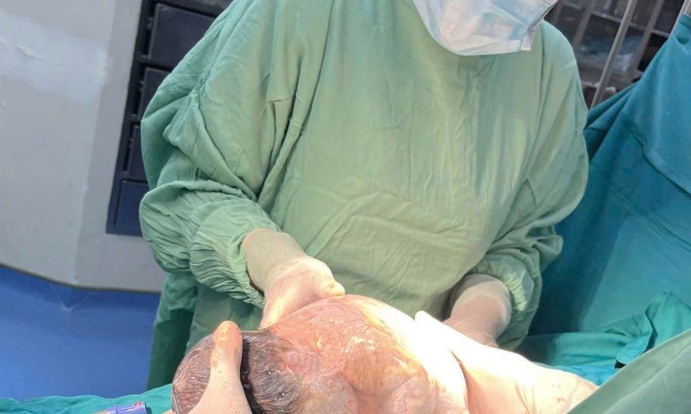 Bé gái sinh ra trong bọc điều tại bệnh viện Hoàn Mỹ Vinh