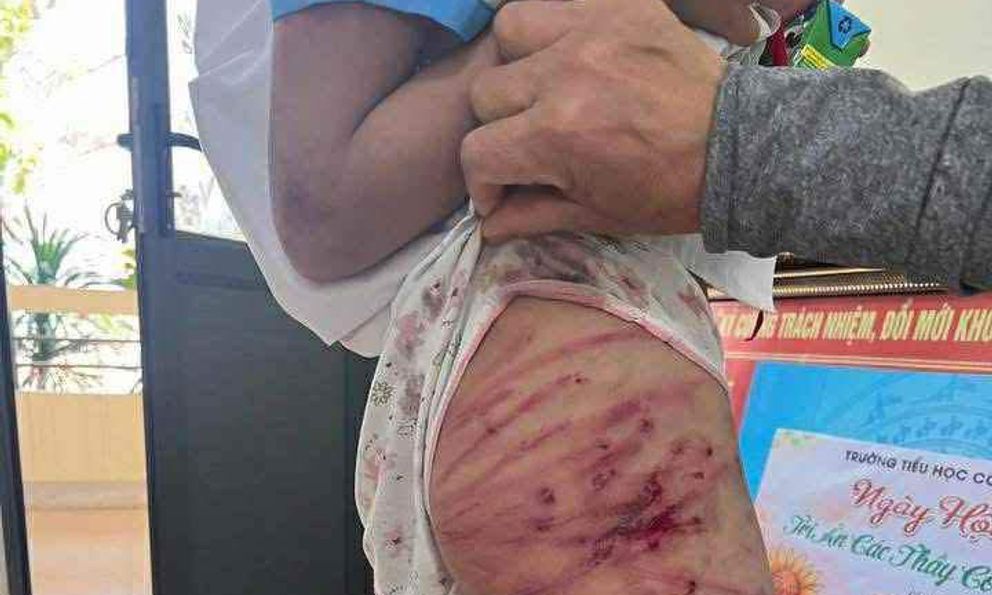 Vụ bé gái lớp 5 bị bạo hành ở Hà Tĩnh: Công an triệu tập cha dượng 