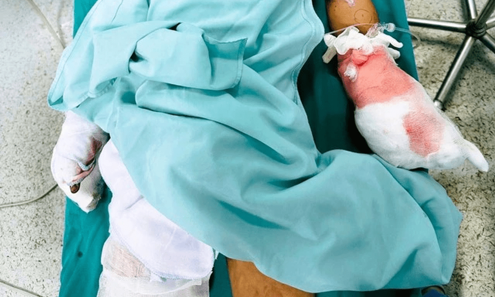 Học sinh lớp 6 bị dập nát bàn tay vì tự chế pháo 