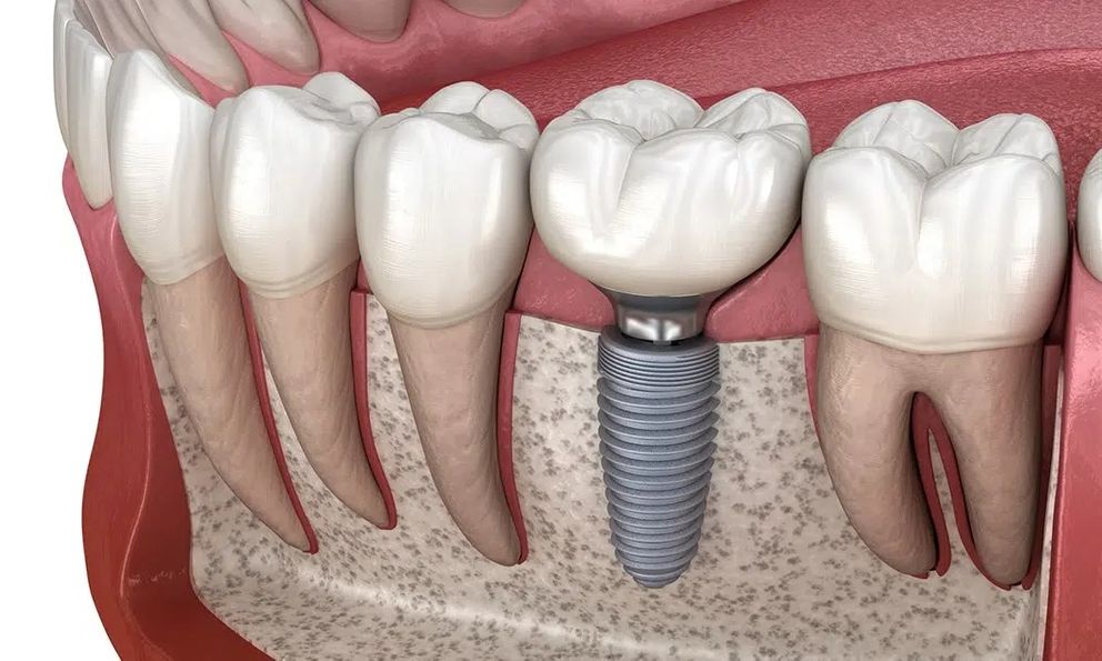 Mách bạn địa chỉ trồng răng chất lượng cao tại Nghệ An