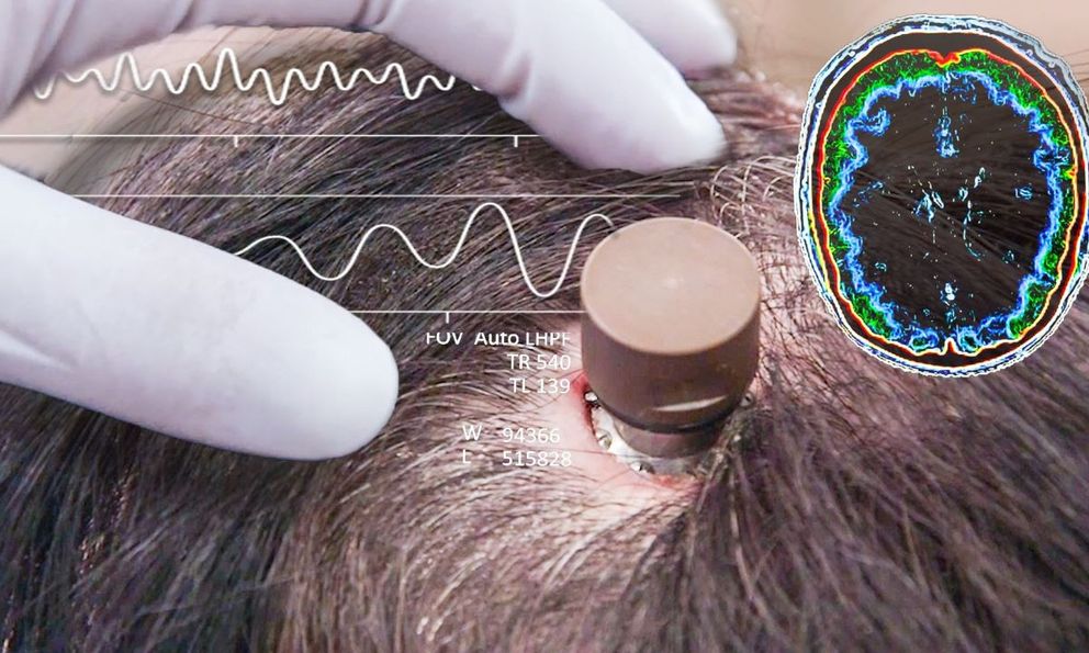 Người đàn ông bị liệt chỉnh sửa video, đăng YouTube 'chỉ bằng suy nghĩ': Ca cấy chip não Neuralink thứ ba gây chấn động