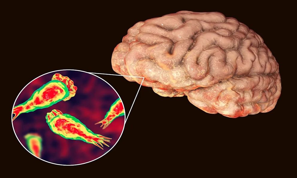 Rất có thể bạn đã bị nhiễm một loại virus ăn não mà bạn chưa từng nghe đến