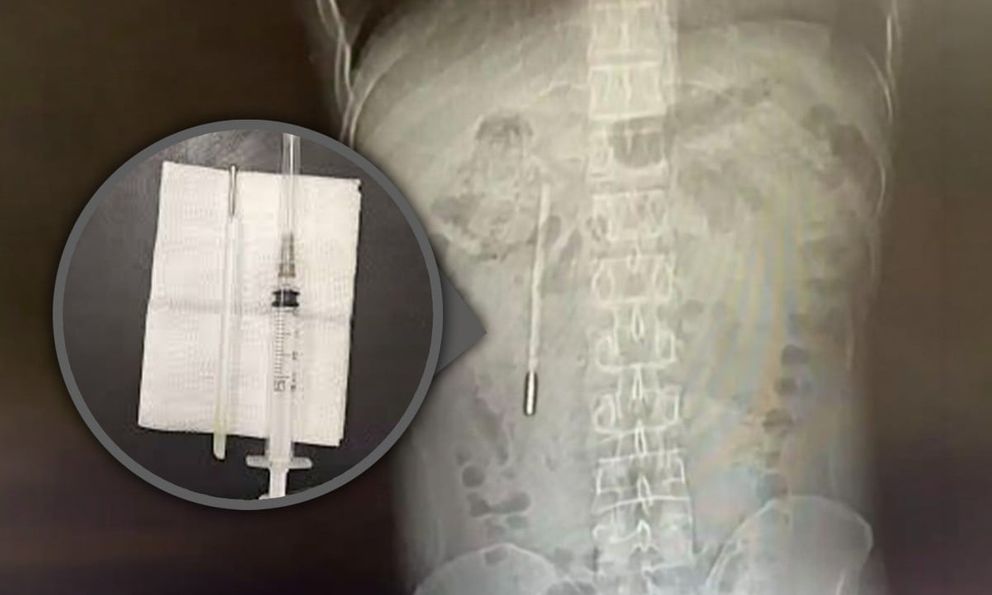 Đi viện vì đau dạ dày, người đàn ông bất ngờ phát hiện chiếc nhiệt kế thủy ngân nằm trong bụng suốt hai mươi năm