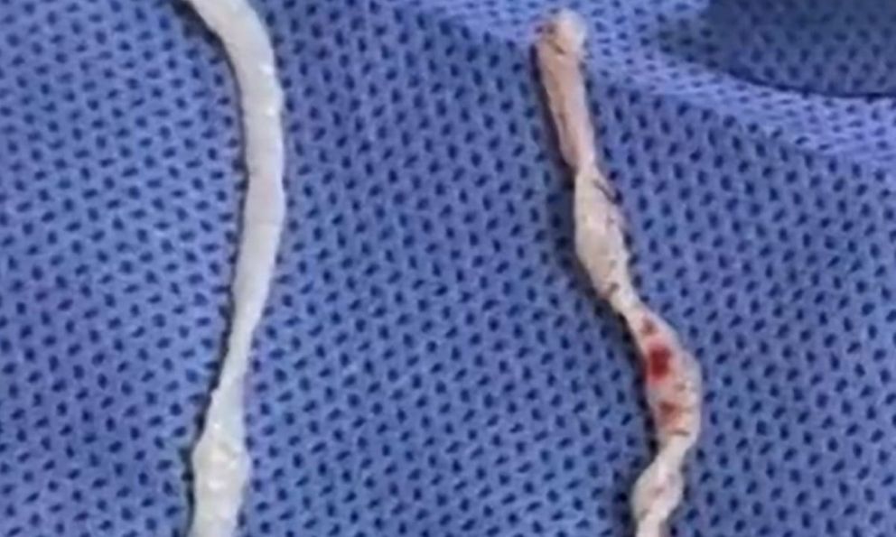 Đau cánh tay suốt một năm, người phụ nữ bàng hoàng khi bác sĩ phát hiện hai sinh vật dài 10cm đang sống dưới da