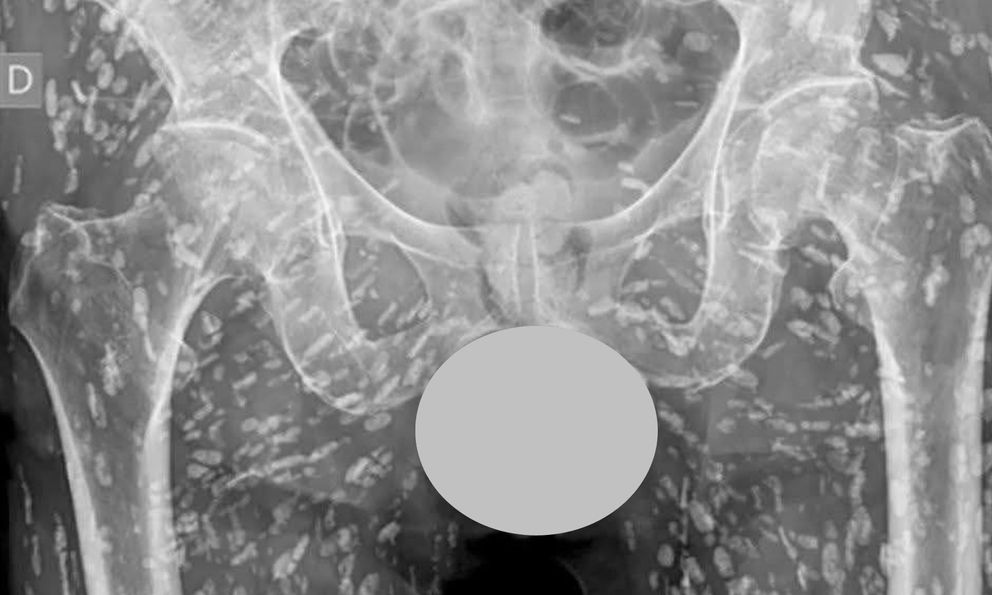 ‘Phát hoảng’ với ảnh chụp X-quang chi chít đốm trắng dọc cơ thể: Bác sĩ chỉ đích danh thủ phạm