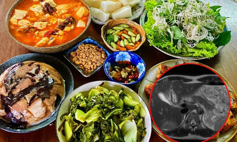 Người phụ nữ Hà Nội bất ngờ phát hiện tổn thương gan: Bác sĩ chỉ đích danh 2 thủ phạm