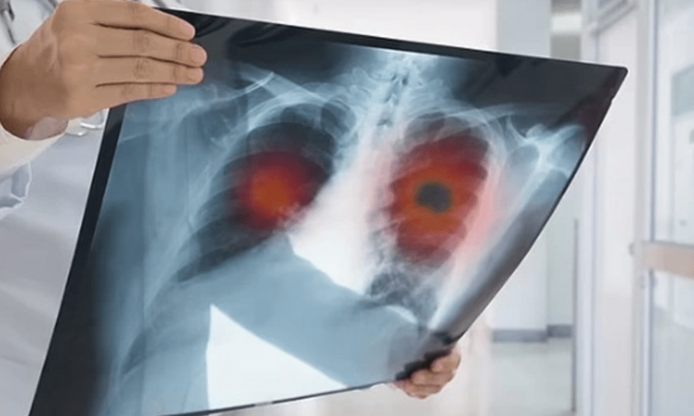 32 tuổi sống lành mạnh, sức khỏe tốt: Có 1 triệu chứng kéo dài 2 tuần, đi khám bỗng nhận kết quả K phổi