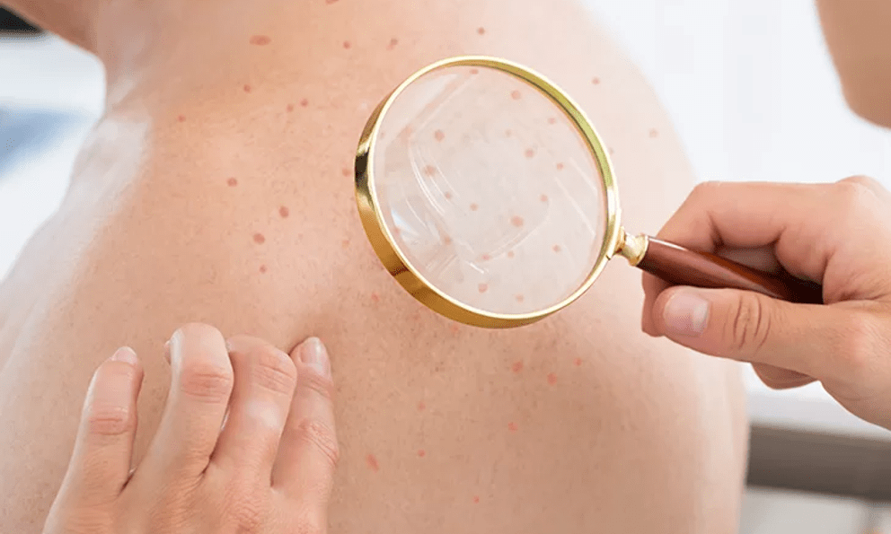 Đi khám da, bàng hoàng phát hiện nhiễm HIV: Tất cả chỉ vì 1 sai lầm của nhiều năm trước