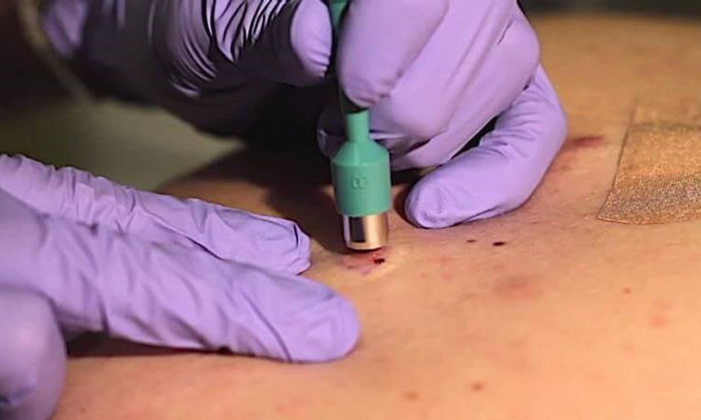 Chỉ vì 1 sai lầm, tế bào ác tính “ăn” mất 1 bên mắt: Bác sĩ cảnh báo dấu hiệu cần nghĩ tới ung thư