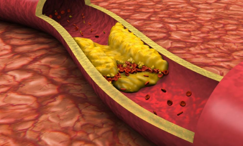 PGS Viện Dinh dưỡng Quốc gia: Đây là thói quen ăn uống khiến mỡ máu cao vút