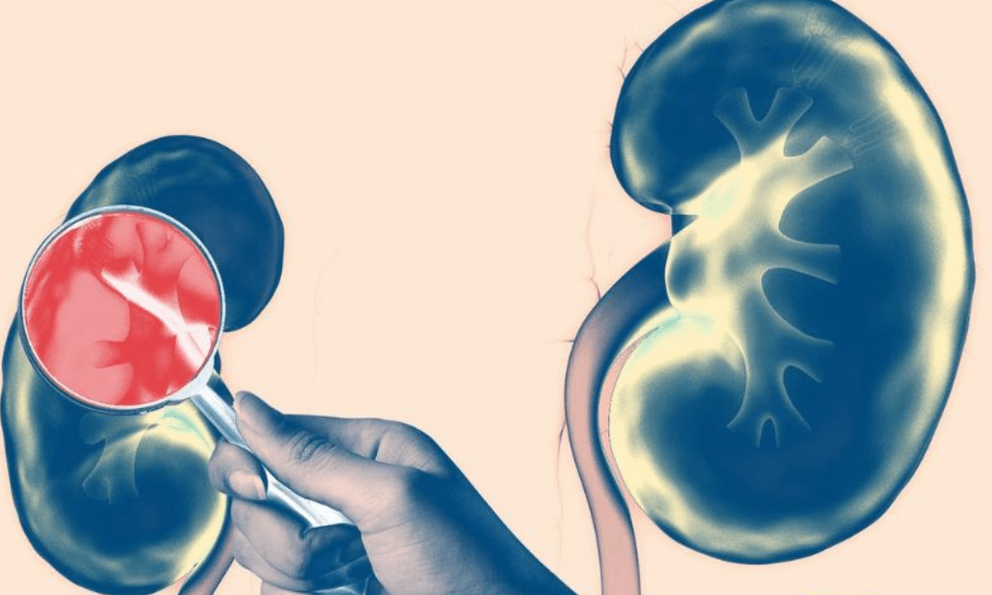 Bàng hoàng phát hiện suy thận sau khi có 1 dấu hiệu tưởng không liên quan