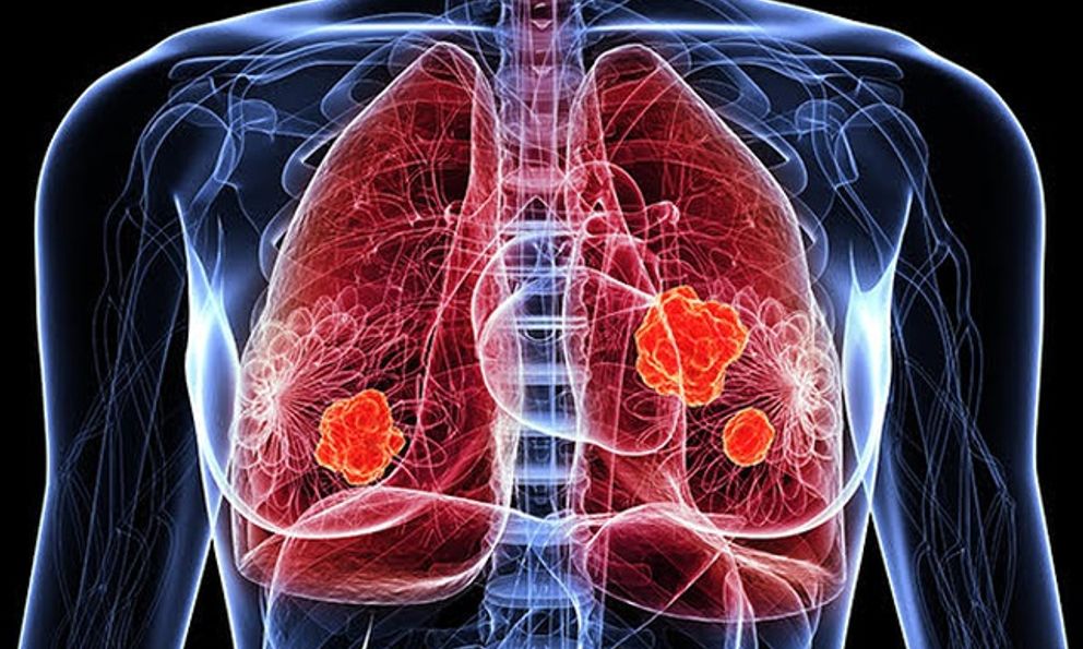 Con số đáng lo ngại về ung thư phổi tại Việt Nam