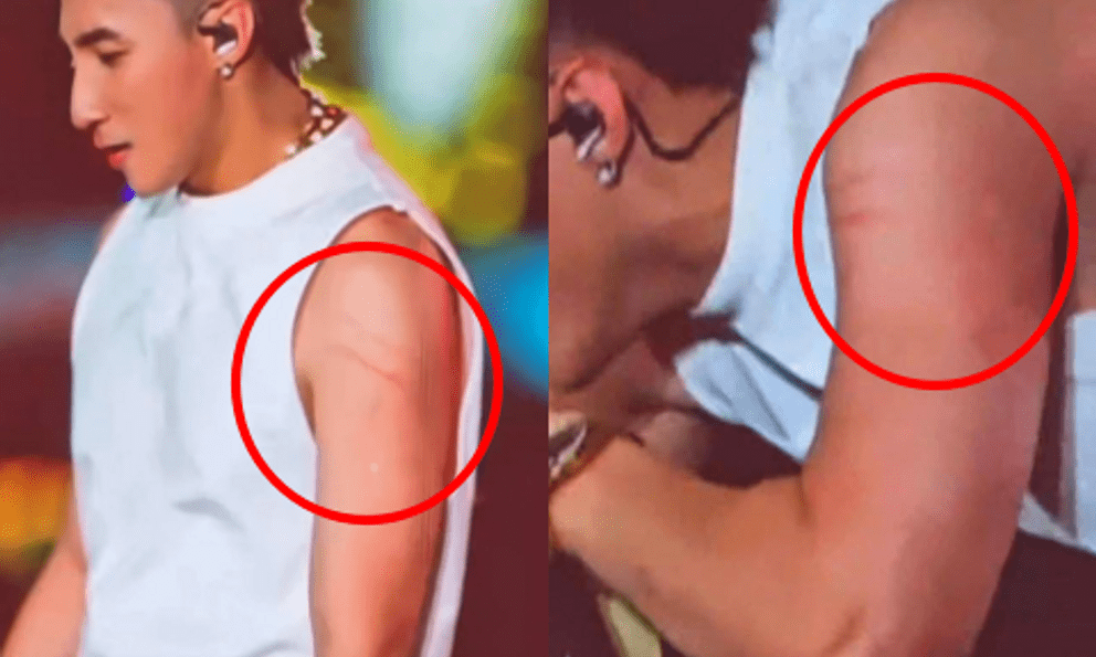 CĂNG: Ảnh cận vết rách da của Sơn Tùng khi bị khán giả 