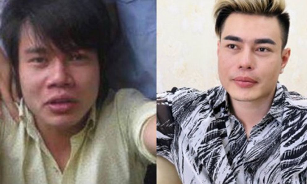 Nam diễn viên sửa cả mặt trừ lỗ tai: “Tôi là nạn nhân của phẫu thuật thẩm mỹ”