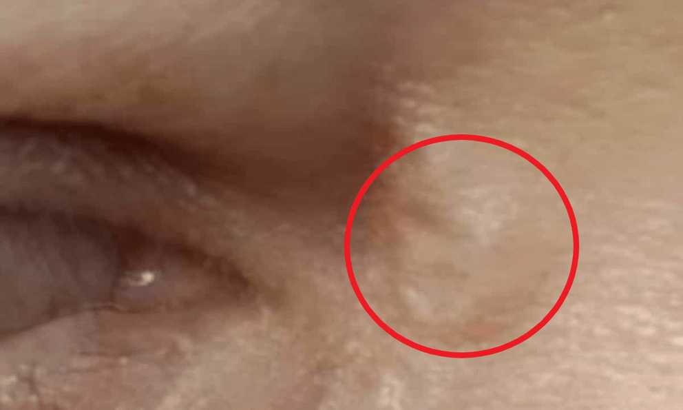 Khối u nhỏ xuất hiện gần mắt, 1 thời gian sau người phụ nữ tá hỏa thấy 1 sinh vật lạ sống trên mặt mình
