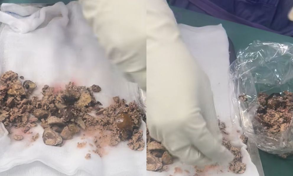 Thấy thứ được lấy ra từ 2 quả thận của bệnh nhân, bác sĩ thốt lên: ‘Sức chịu đựng quá phi thường’