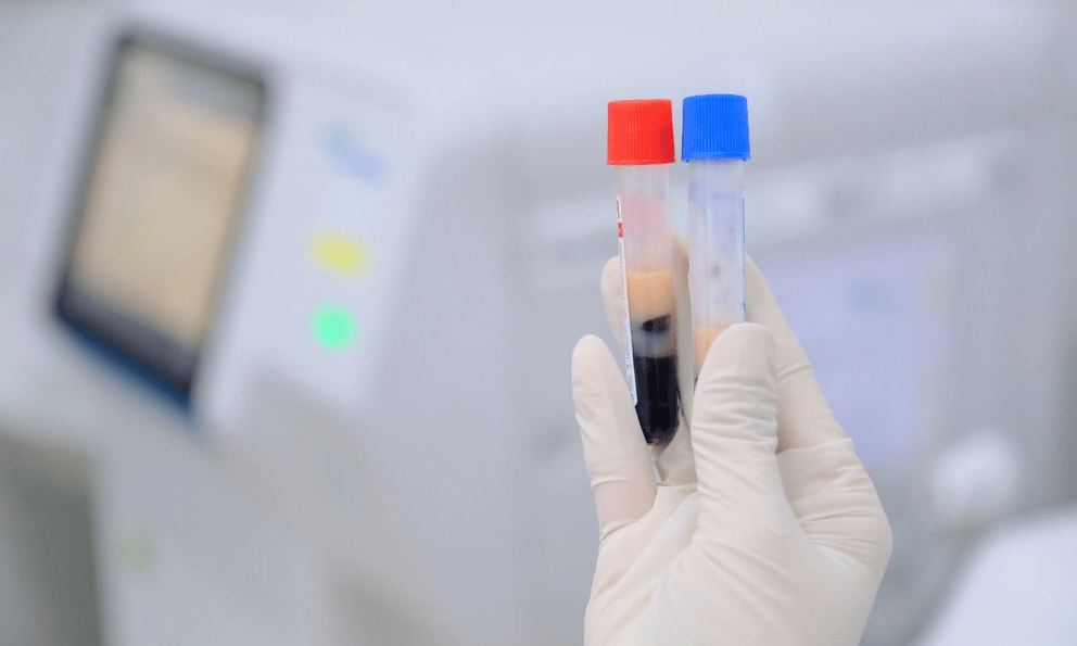 29 tuổi, mỡ máu cao vút dù ăn uống khoa học, cân nặng bình thường: Không ngờ lý do là điều này