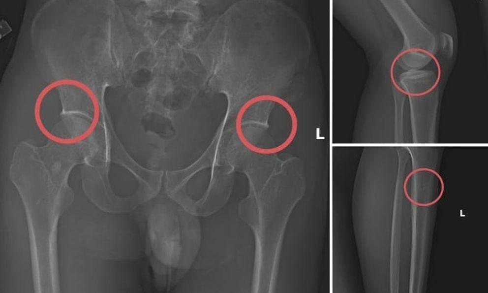 Vụ tự đục gãy xương để chiếm đoạt hơn 6 tỷ đồng tiền bảo hiểm: Bác sĩ thốt lên 