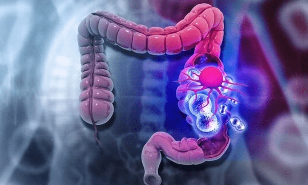 Ung thư đại trực tràng ở người trẻ ngày càng gia tăng, 