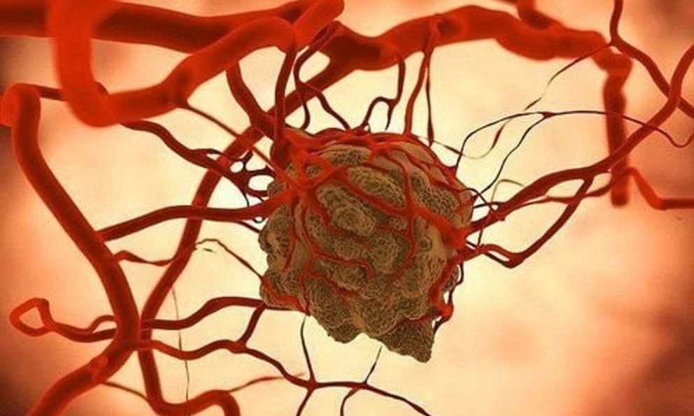 Vượt qua ung thư gan, đây là căn bệnh ung thư có tỷ lệ mắc cao số 1 ở người Việt: Có tính di truyền