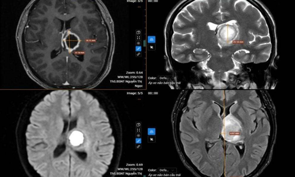 Thường xuyên buồn ngủ, đi khám “sốc” nặng khi biết nguyên nhân