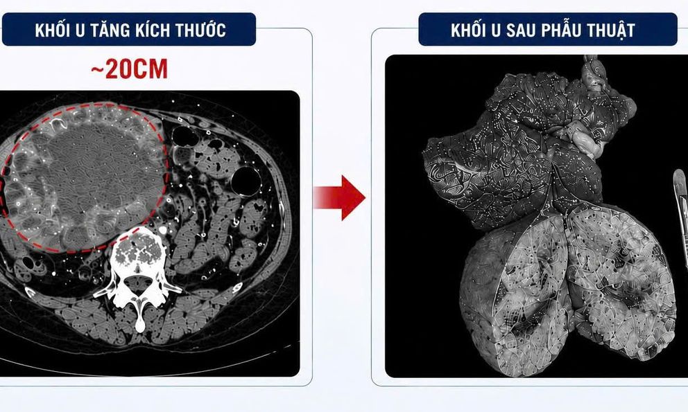 Khối u gan “lớn nhanh như thổi”, tăng kích thước 10 lần sau khi uống loại nước này thường xuyên