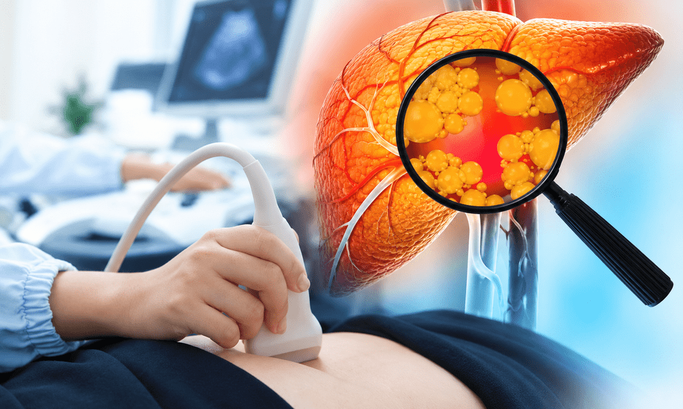 Chăm tập thể dục, kiêng chất béo nhưng gan vẫn nhiễm mỡ: Bác sĩ Bạch Mai chỉ ra nguyên nhân