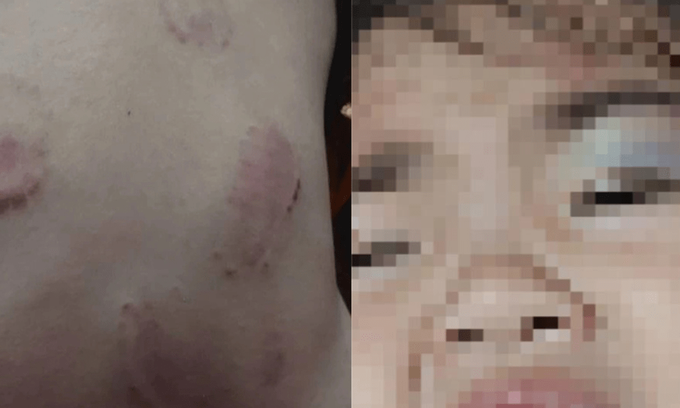 Cho con đi học mầm non, đến khi đón con về, bà mẹ ở An Giang phát hiện hàng loạt vết bầm và dấu răng