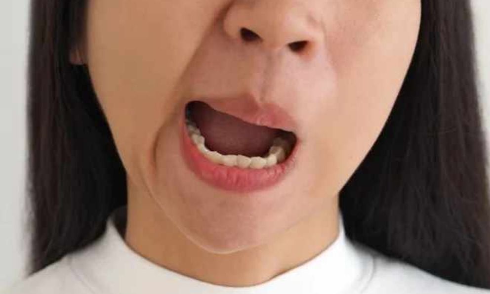 Cảnh báo bệnh liệt mặt 