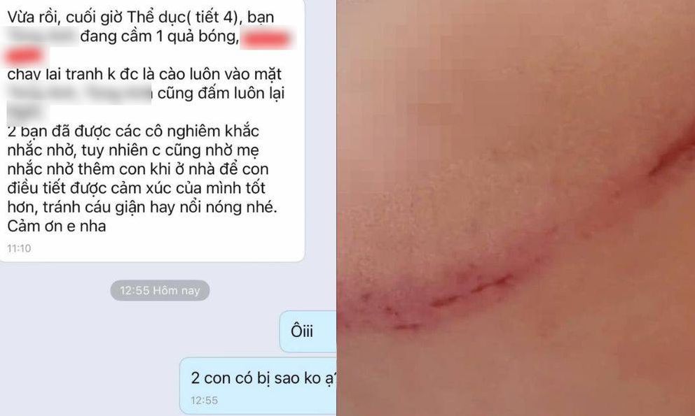 Nhìn 2 vết xước trên mặt học sinh Hà Nội này mà xót: Câu chuyện phía sau thổi bùng tranh luận 