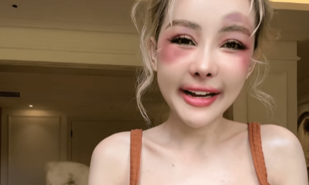 Nữ hoàng thẩm mỹ Ngân 98 gặp sự cố đau đớn, hé lộ về lần phẫu thuật tiếp theo