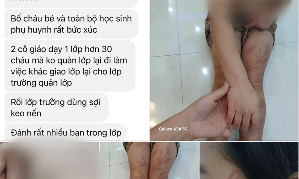 Vụ trẻ mầm non 5 tuổi đánh bạn cùng lớp bầm tím ở Nghệ An: Tạm dừng công tác giáo viên phụ trách 