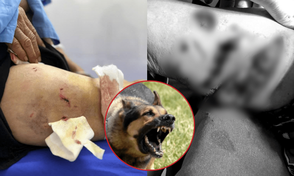 Kinh hoàng cụ bà 77 tuổi ở Yên Bái bị đàn chó lao vào tấn công, chi chít vết thương trên cơ thể