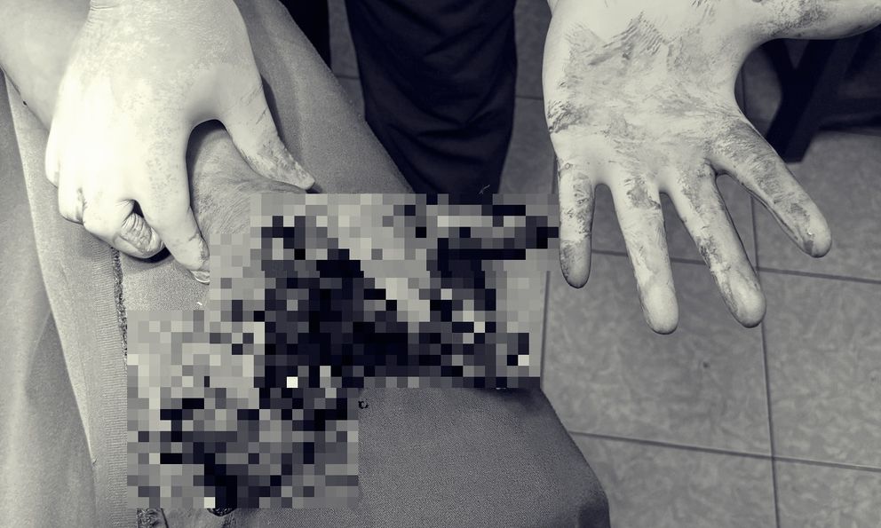 Điện thoại phát nổ khi đang cắm sạc, người đàn ông 42 tuổi dập nát bàn tay, chảy nhiều máu