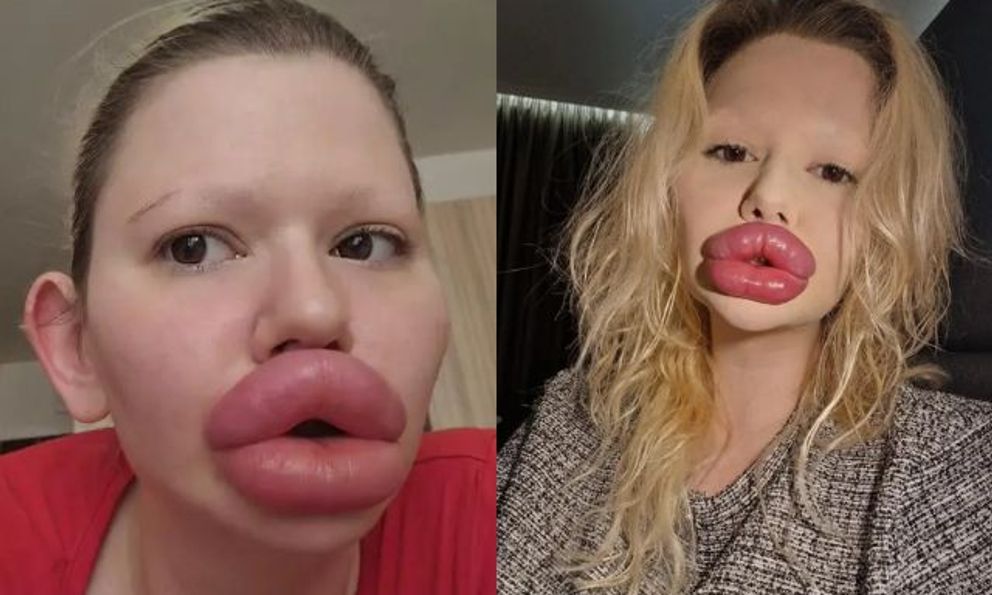 Lộ ảnh trước phẫu thuật gây sốc của “người phụ nữ có đôi môi lớn nhất thế giới”: Ai nấy đều sửng sốt