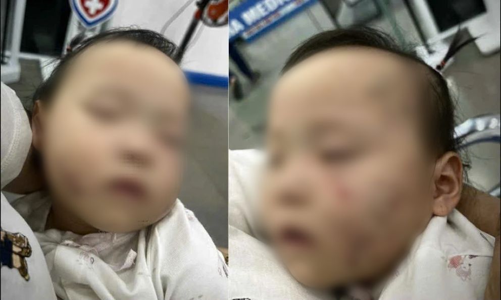 Vụ bé gái bầm tím mặt, có vết răng cắn sau khi đi học mầm non tư thục: Thông tin bất ngờ về cô giáo