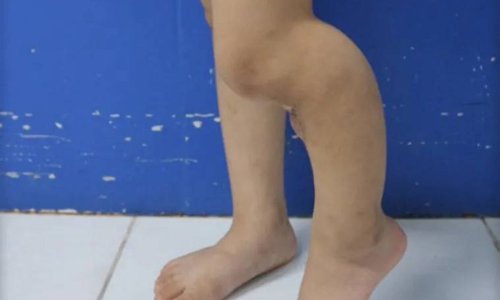 Bé gái 5 tuổi gãy xương đã được bó bột, bố mẹ vẫn khoét lỗ trên bột để đắp lá khiến xương không thể liền