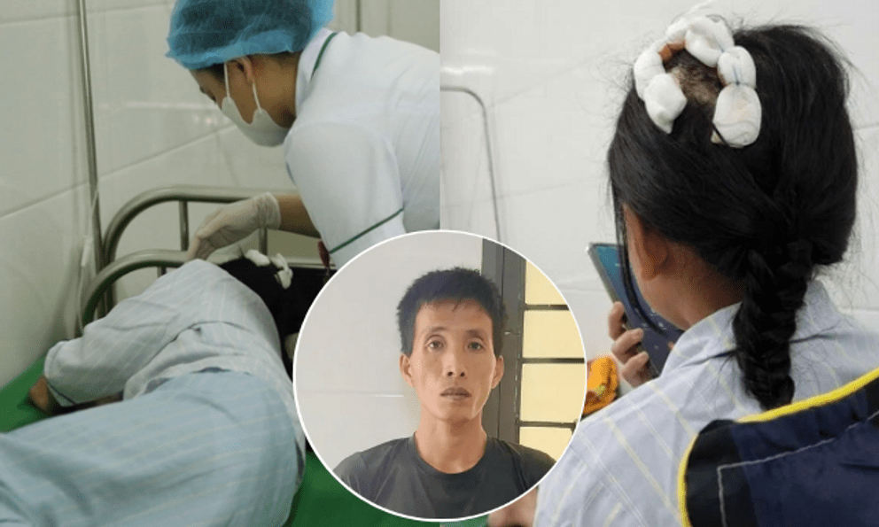Sức khỏe của bé gái bị cha dượng dùng búa đánh vào đầu hiện ra sao?